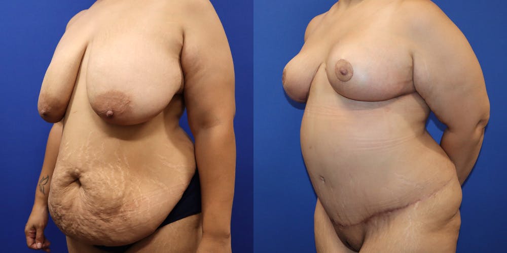 Breast Reduction Before & After Gallery - Patient 300104 - Image 4