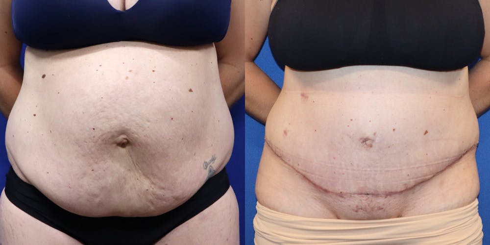 Tummy Tuck Before & After Gallery - Patient 130825 - Image 1