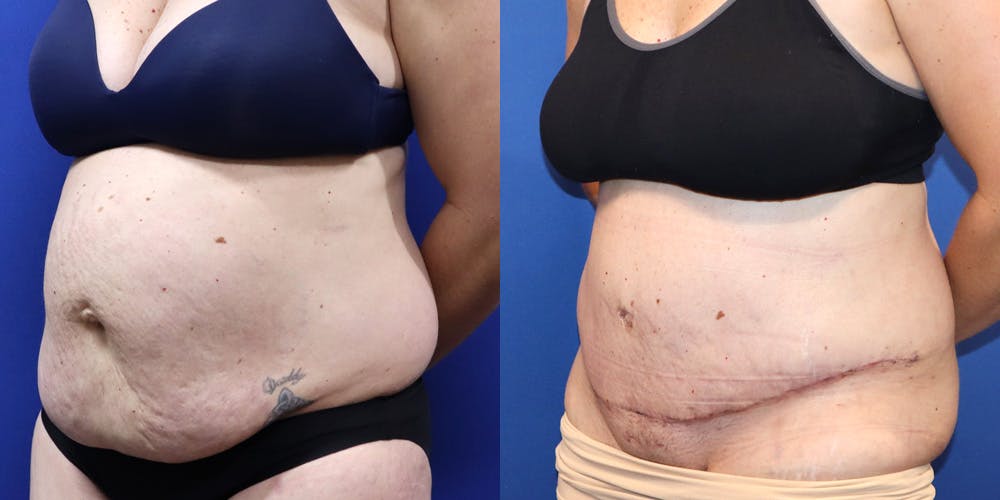 Tummy Tuck Before & After Gallery - Patient 130825 - Image 4