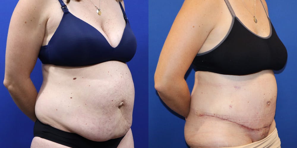 Tummy Tuck Before & After Gallery - Patient 130825 - Image 2