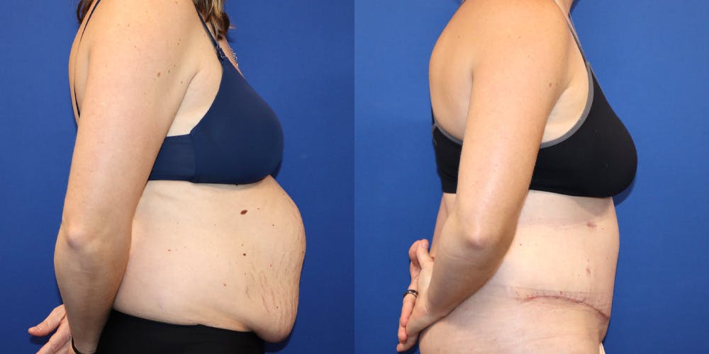 Tummy Tuck Before & After Gallery - Patient 130825 - Image 3