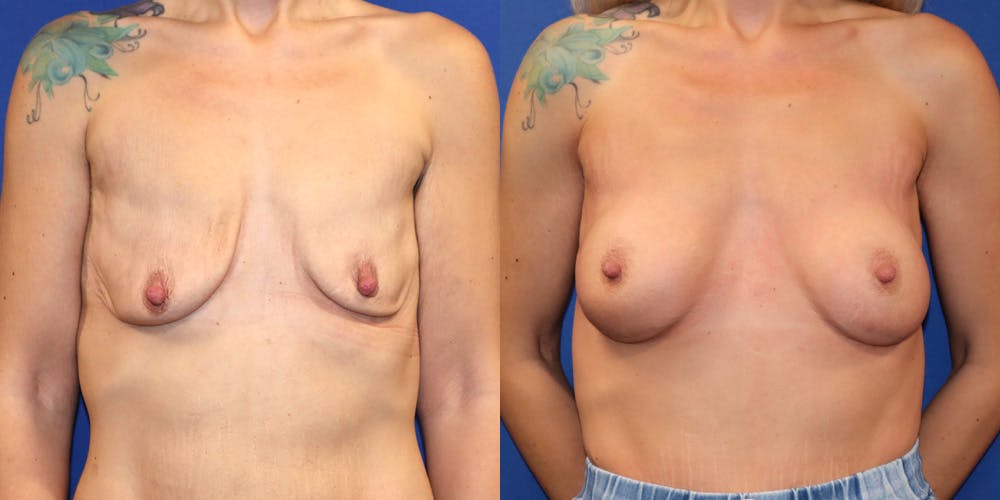 Breast Augmentation Before & After Gallery - Patient 176971 - Image 1