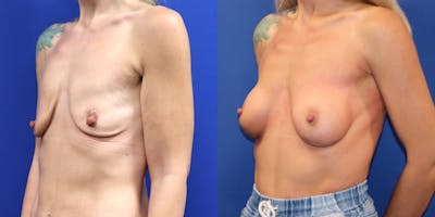 Breast Augmentation Before & After Gallery - Patient 176971 - Image 4