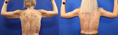 Arm Lift Before & After Gallery - Patient 144211732 - Image 1
