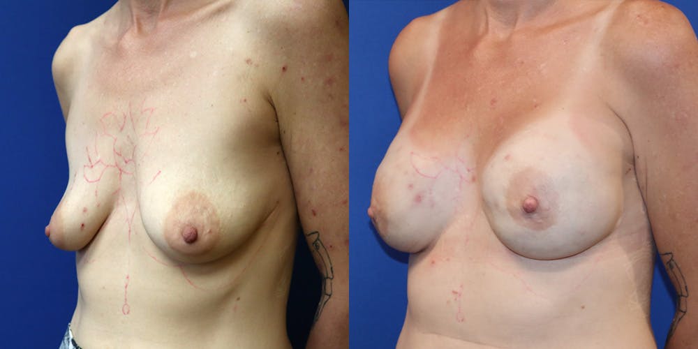 Breast Reconstruction Before & After Gallery - Patient 697877 - Image 4