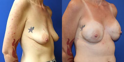 Breast Reconstruction Before & After Gallery - Patient 697877 - Image 2