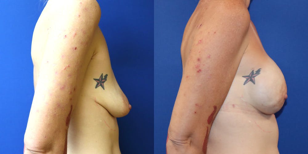 Breast Reconstruction Before & After Gallery - Patient 697877 - Image 3