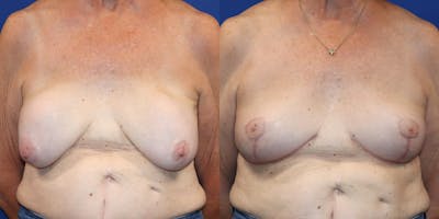 Breast Augmentation Revision Before & After Gallery - Patient 364716 - Image 1