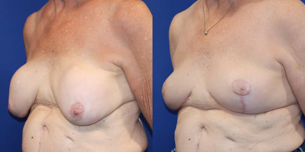 Breast Augmentation Revision Before & After Gallery - Patient 364716 - Image 4