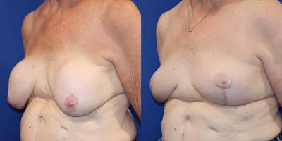 Breast Augmentation Revision Before & After Gallery - Patient 364716 - Image 4