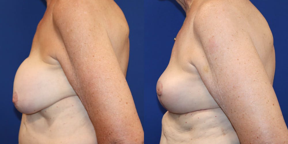 Breast Augmentation Revision Before & After Gallery - Patient 364716 - Image 5