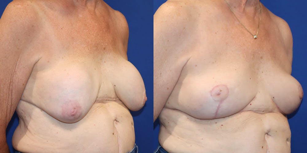Breast Augmentation Revision Before & After Gallery - Patient 364716 - Image 2