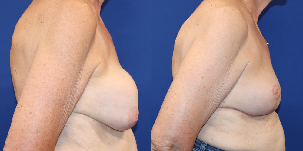 Breast Augmentation Revision Before & After Gallery - Patient 364716 - Image 3