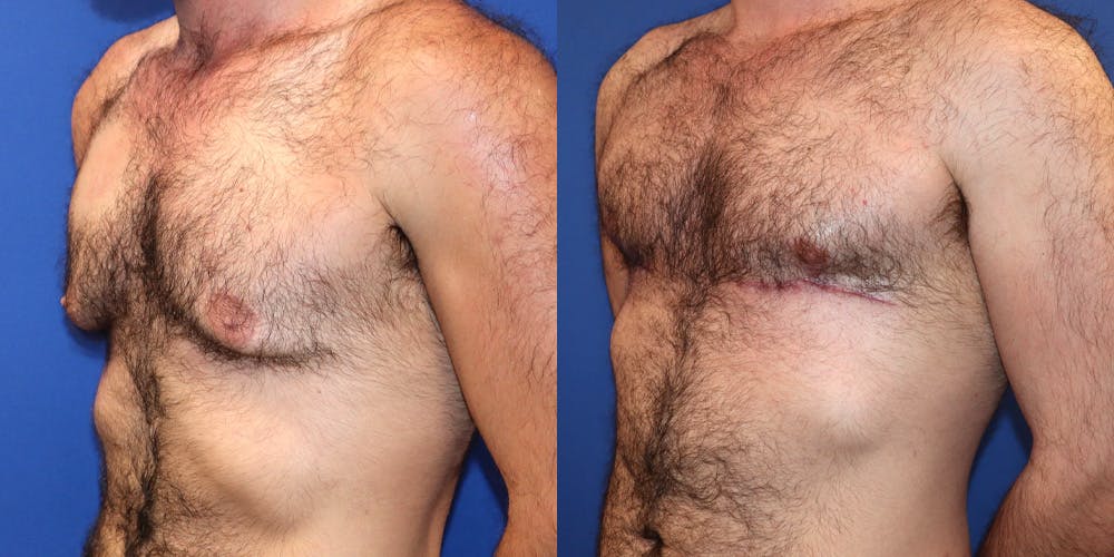 Gynecomastia Before & After Gallery - Patient 325405 - Image 4