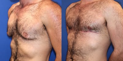 Gynecomastia Before & After Gallery - Patient 325405 - Image 4