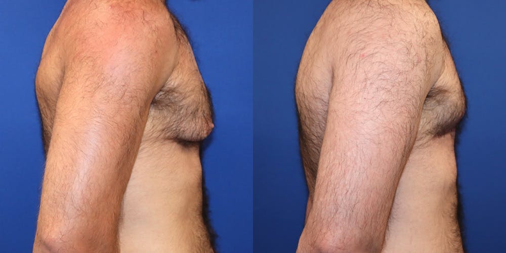Gynecomastia Before & After Gallery - Patient 325405 - Image 3