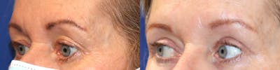 Eyelid Surgery Before & After Gallery - Patient 202655 - Image 4