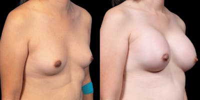 MTF Top Surgery Before & After Gallery - Patient 142835 - Image 2
