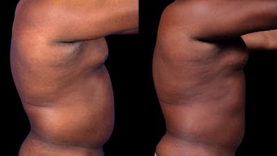 Laser Liposuction Before & After Gallery - Patient 401984 - Image 1