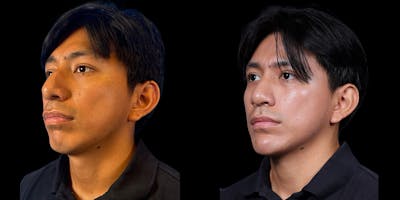 Chin Before & After Gallery - Patient 179752091 - Image 4