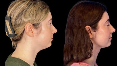Neck Lift Before & After Gallery - Patient 355519 - Image 1