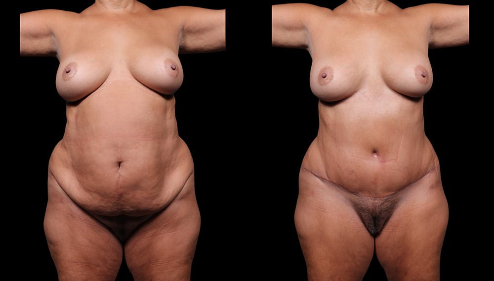 Tummy Tuck Before & After Gallery - Patient 235861 - Image 2