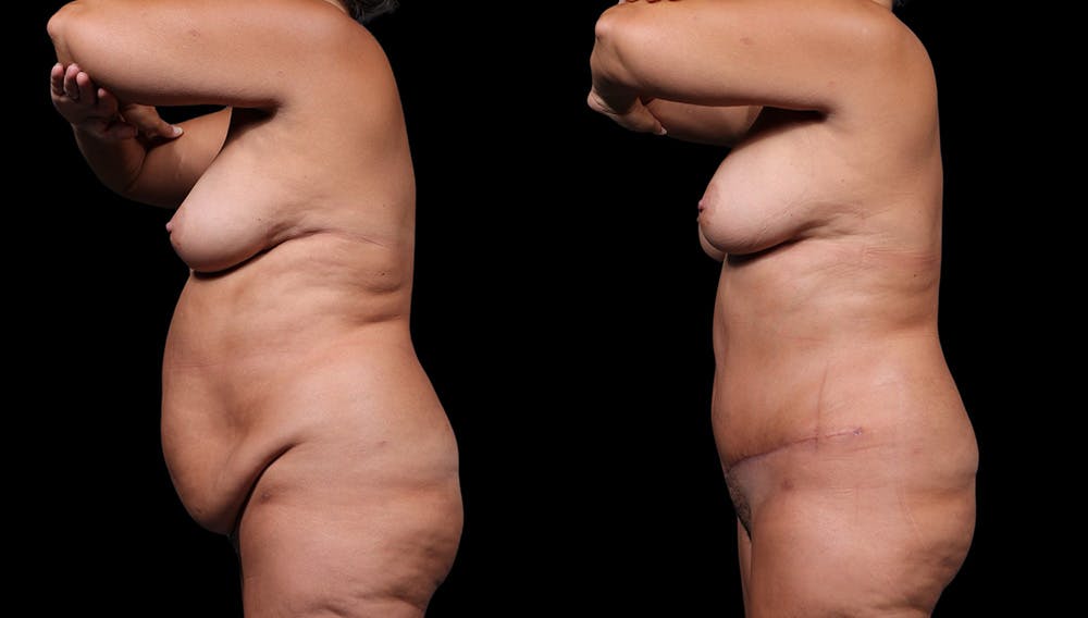 Tummy Tuck Before & After Gallery - Patient 235861 - Image 6