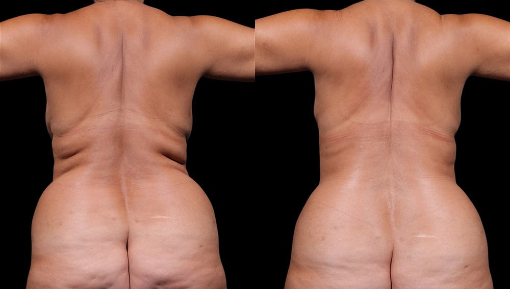 Tummy Tuck Before & After Gallery - Patient 235861 - Image 7