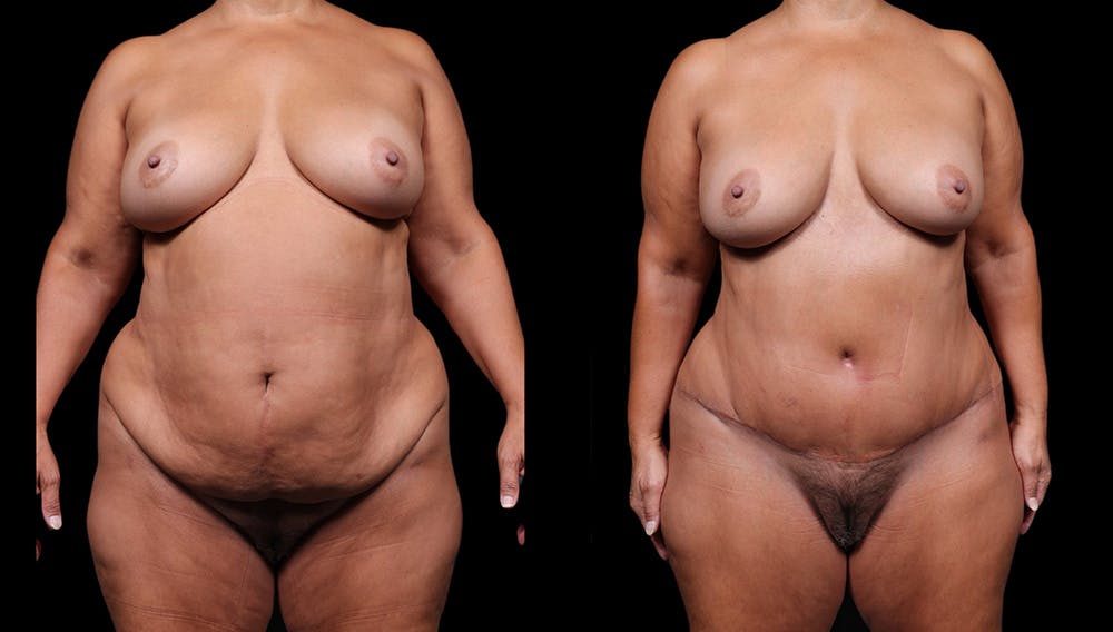Tummy Tuck Before & After Gallery - Patient 235861 - Image 1