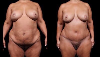 Tummy Tuck Before & After Gallery - Patient 235861 - Image 1