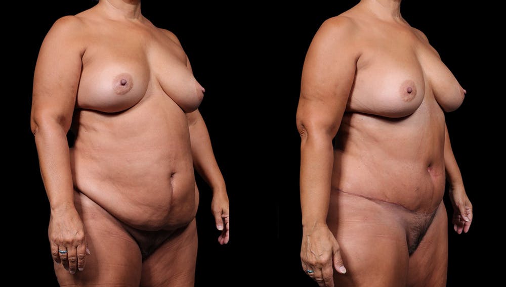 Tummy Tuck Before & After Gallery - Patient 235861 - Image 3