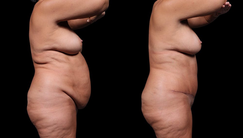 Tummy Tuck Before & After Gallery - Patient 235861 - Image 4