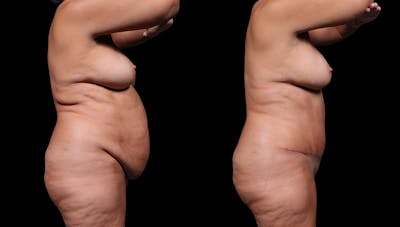 Tummy Tuck Before & After Gallery - Patient 235861 - Image 4