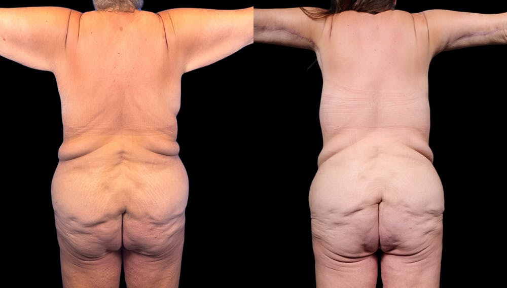 Tummy Tuck Before & After Gallery - Patient 282362 - Image 6