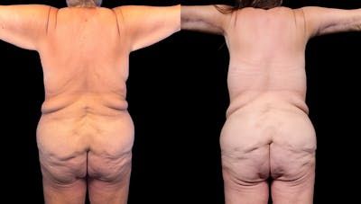 Tummy Tuck Before & After Gallery - Patient 282362 - Image 6