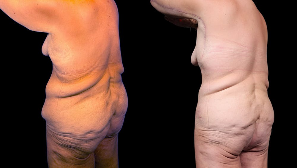 Tummy Tuck Before & After Gallery - Patient 282362 - Image 5