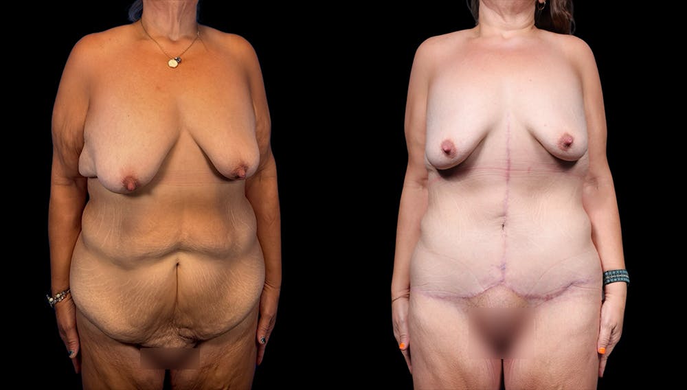 Tummy Tuck Before & After Gallery - Patient 282362 - Image 1