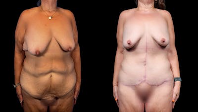 Tummy Tuck Before & After Gallery - Patient 282362 - Image 1