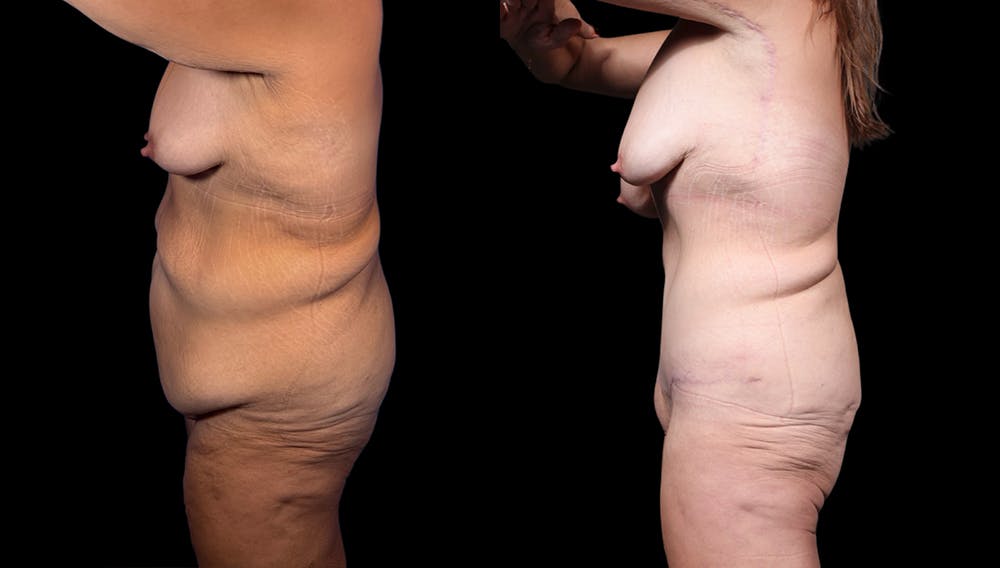 Tummy Tuck Before & After Gallery - Patient 282362 - Image 4