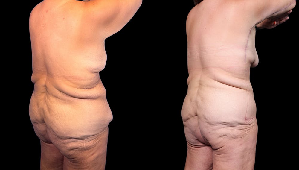 Tummy Tuck Before & After Gallery - Patient 282362 - Image 7