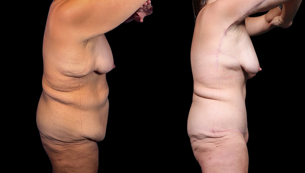 Tummy Tuck Before & After Gallery - Patient 282362 - Image 8