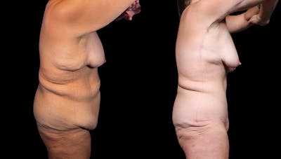 Tummy Tuck Before & After Gallery - Patient 282362 - Image 8