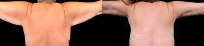 Arm Lift Before & After Gallery - Patient 187506 - Image 1