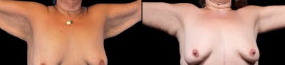 Arm Lift Before & After Gallery - Patient 187506 - Image 2