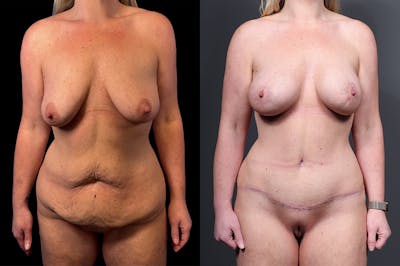 Mommy Makeover Before & After Gallery - Patient 321885 - Image 1