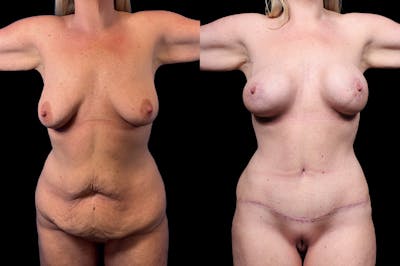 Mommy Makeover Before & After Gallery - Patient 321885 - Image 2