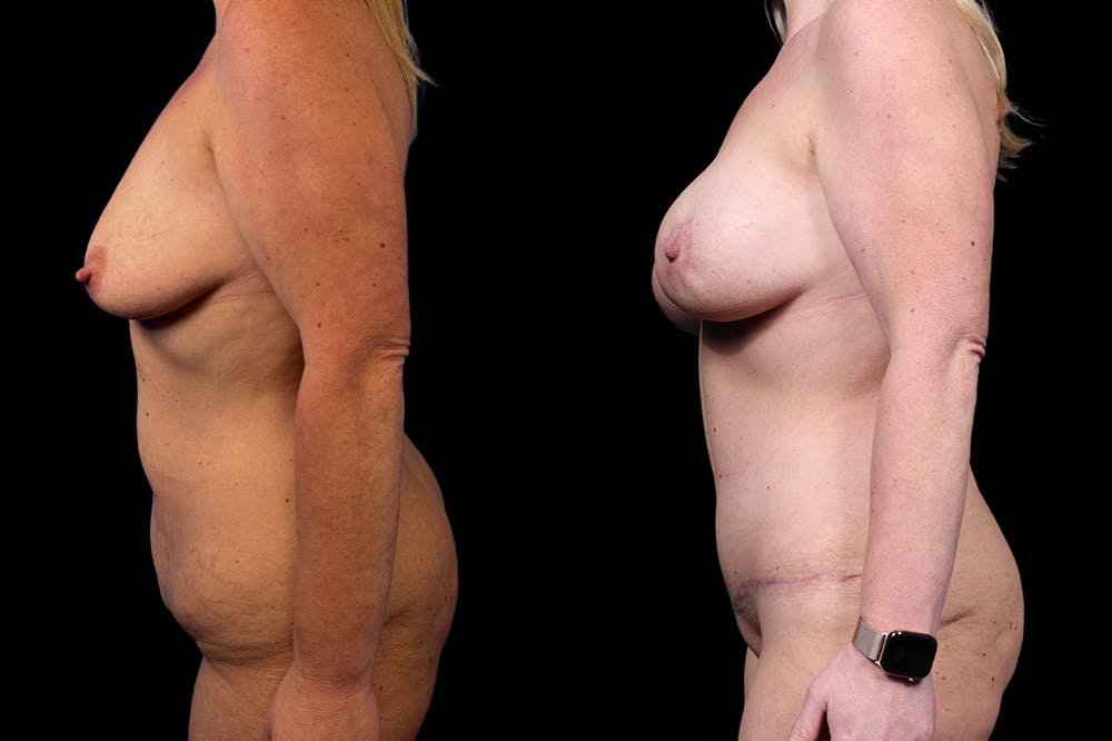 Mommy Makeover Before & After Gallery - Patient 321885 - Image 6