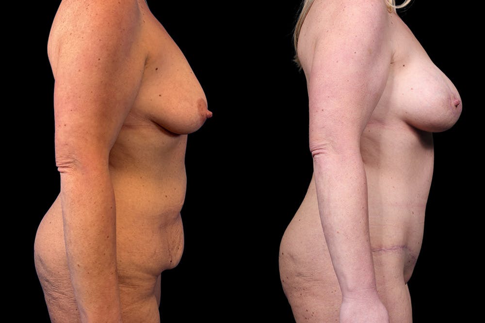 Mommy Makeover Before & After Gallery - Patient 321885 - Image 4