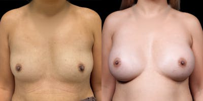Breast Augmentation Before & After Gallery - Patient 278629 - Image 1