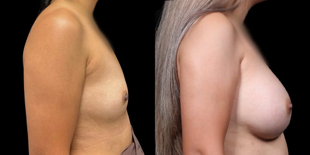 Breast Augmentation Before & After Gallery - Patient 278629 - Image 3